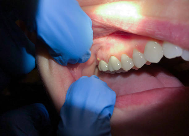 Best Emergency Root Canal Treatment in Grafton, WV